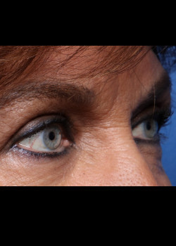 Blepharoplasty result at Watterson Plastic Surgery