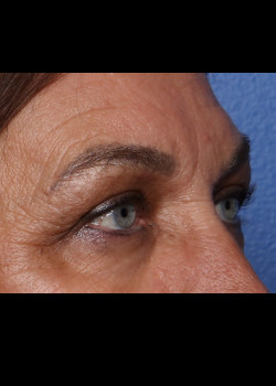 Blepharoplasty before photo