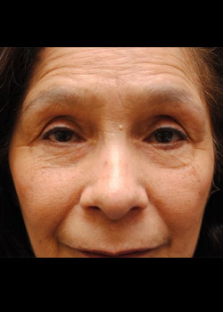 Blepharoplasty result at Watterson Plastic Surgery