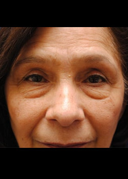 Blepharoplasty before photo