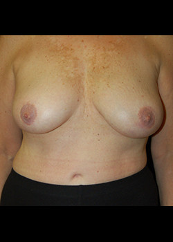 Breast Lift result at Watterson Plastic Surgery