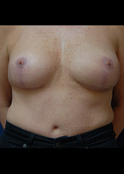 Breast Lift before photo
