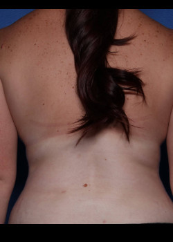 Liposuction result at Watterson Plastic Surgery