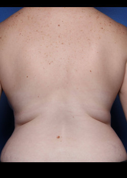 Liposuction before photo