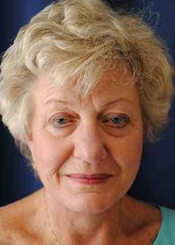 Watterson Plastic Surgery facelift after — Draper, UT