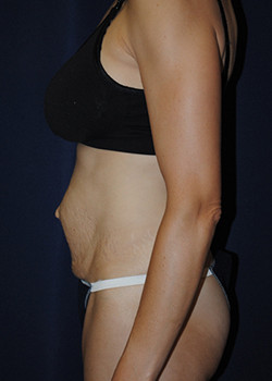Mommy Makeover before photo