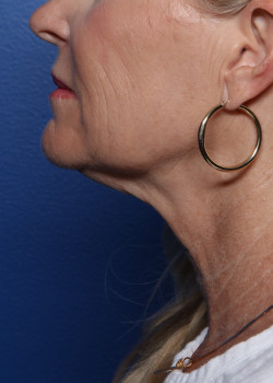 Facelift