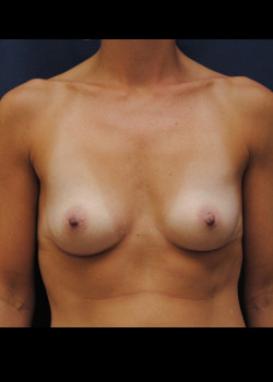 Procedure before photo