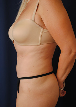 Tummy Tuck result at Watterson Plastic Surgery