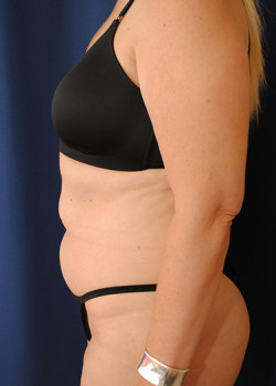 Tummy Tuck before photo