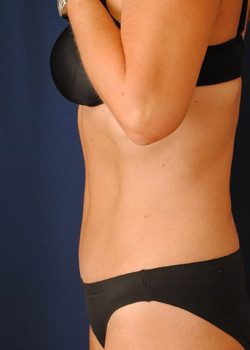 Tummy Tuck result at Watterson Plastic Surgery