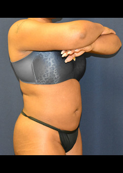 Liposuction result at Watterson Plastic Surgery