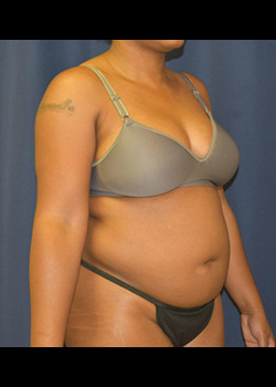 Liposuction before photo