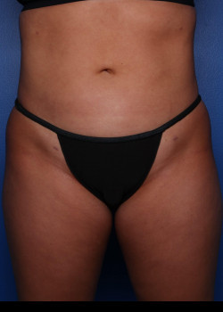 Liposuction result at Watterson Plastic Surgery
