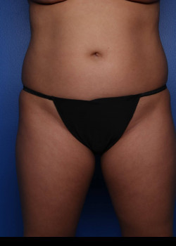 Liposuction before photo
