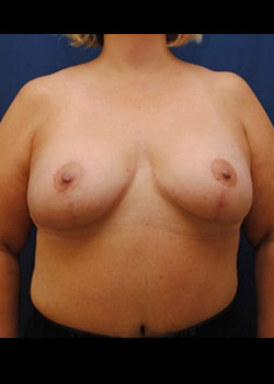 Breast Reduction result at Watterson Plastic Surgery