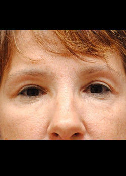 Blepharoplasty result at Watterson Plastic Surgery