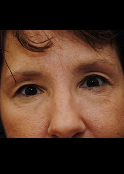 Blepharoplasty before photo