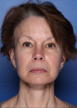 Watterson Plastic Surgery facelift after — Draper, UT
