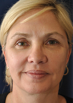 Watterson Plastic Surgery facelift after — Draper, UT