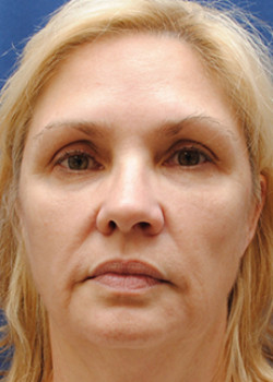 Facelift