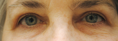 Blepharoplasty result at Watterson Plastic Surgery