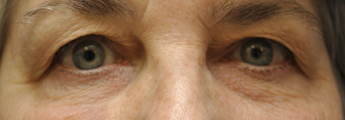 Blepharoplasty before photo