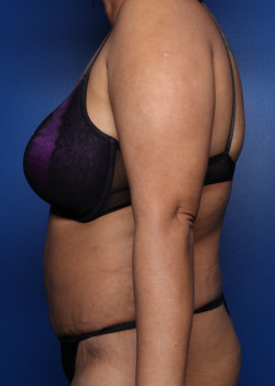 Tummy Tuck result at Watterson Plastic Surgery