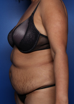 Tummy Tuck before photo