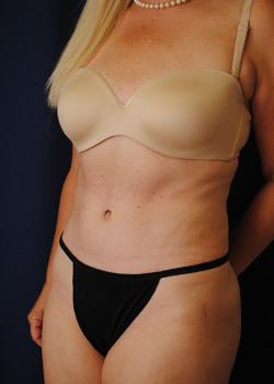 Tummy Tuck result at Watterson Plastic Surgery