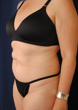 Tummy Tuck before photo