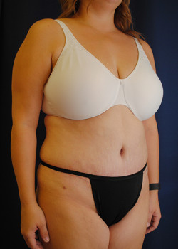 Watterson Plastic Surgery tummy tuck after — Draper, UT