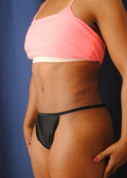 Tummy Tuck result at Watterson Plastic Surgery