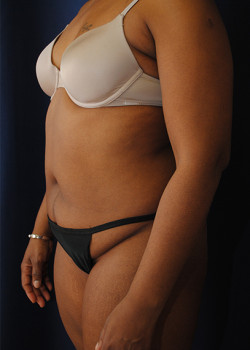 Tummy Tuck before photo