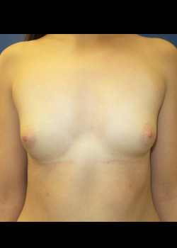 Breast Augmentation before photo