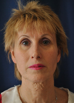 Procedure before photo