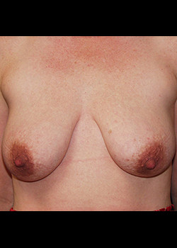 Breast Lift before photo