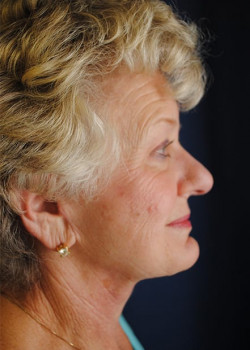 Watterson Plastic Surgery facelift after — Draper, UT
