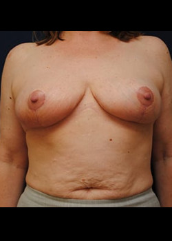 Breast Reduction result at Watterson Plastic Surgery