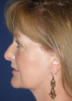 Watterson Plastic Surgery facelift after — Draper, UT