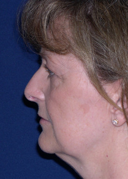 Facelift