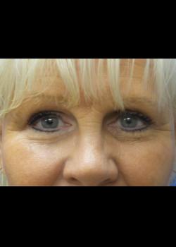 Blepharoplasty result at Watterson Plastic Surgery