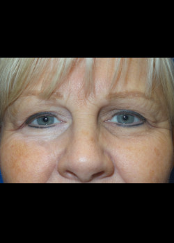 Blepharoplasty before photo