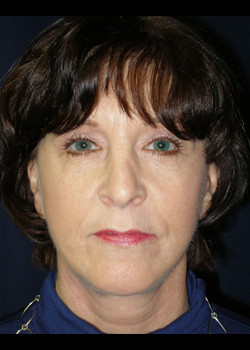 Watterson Plastic Surgery facelift after — Draper, UT