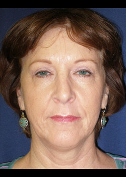 Facelift