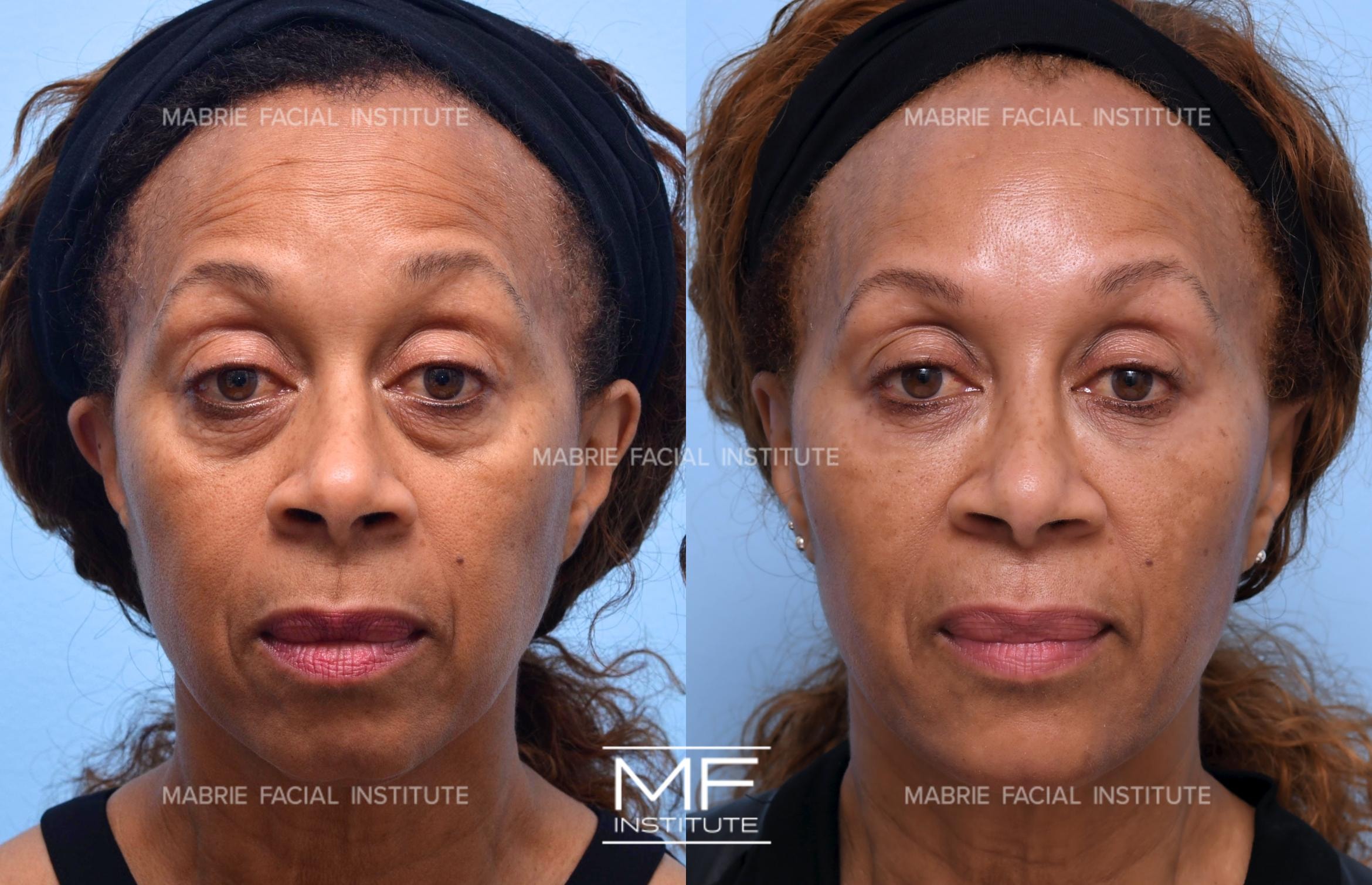 A result from Mabrie Facial Institute