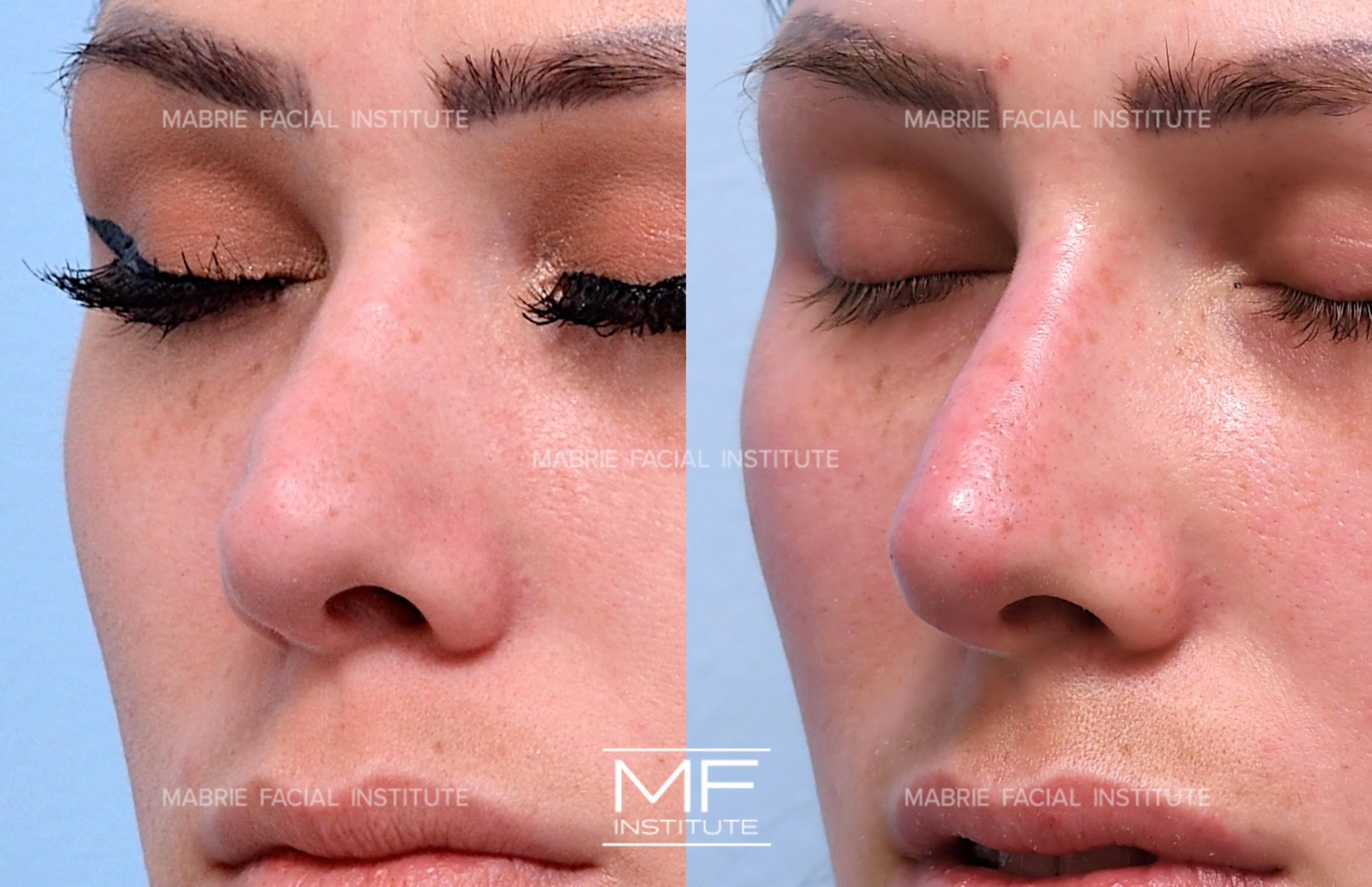 A result from Mabrie Facial Institute