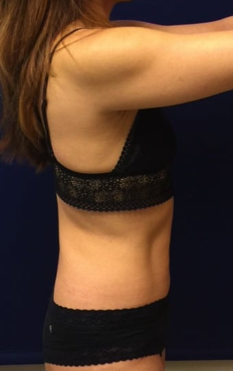 A result from Pacific Plastic Surgery Institute - Joyce Chen MD