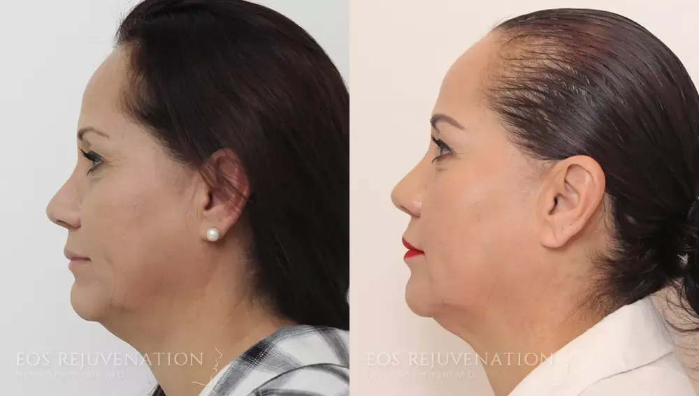 Procedure result at Eos Rejuvenation