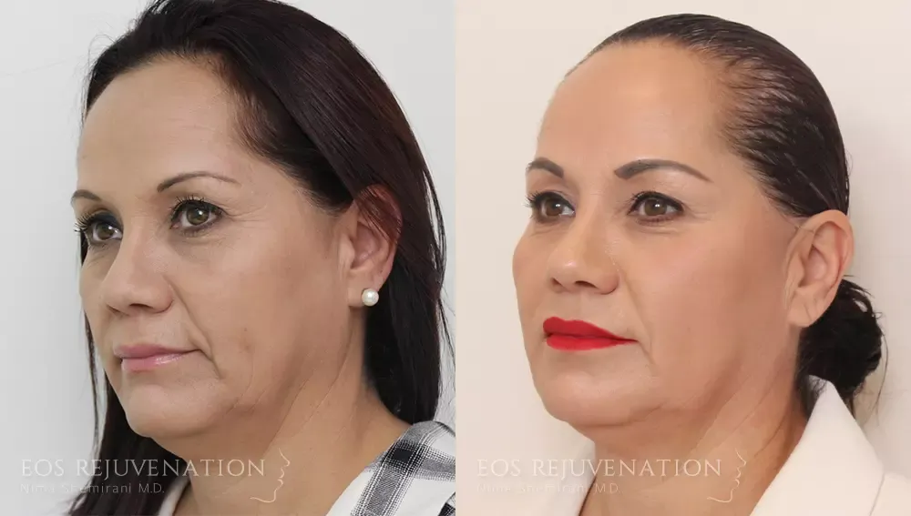Procedure before photo